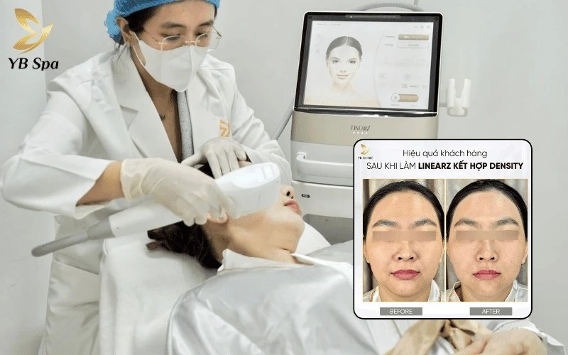 Xóa mờ nếp nhăn và siết chặt các vùng cơ chảy xệ hiệu quả bằng bộ đôi công nghệ nâng cơ trẻ hóa không xâm lấn tại YB Spa