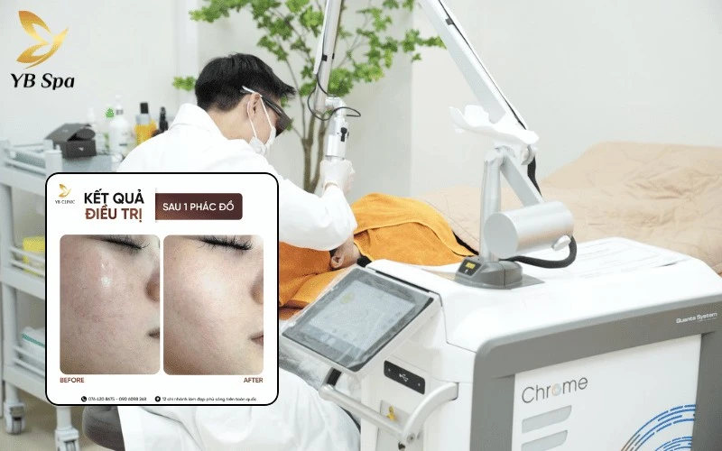 Tái tạo làn da đều màu và khỏe khoắn với liệu trình điều trị giãn mao mạch chuyên sâu bằng công nghệ Laser Chrome
