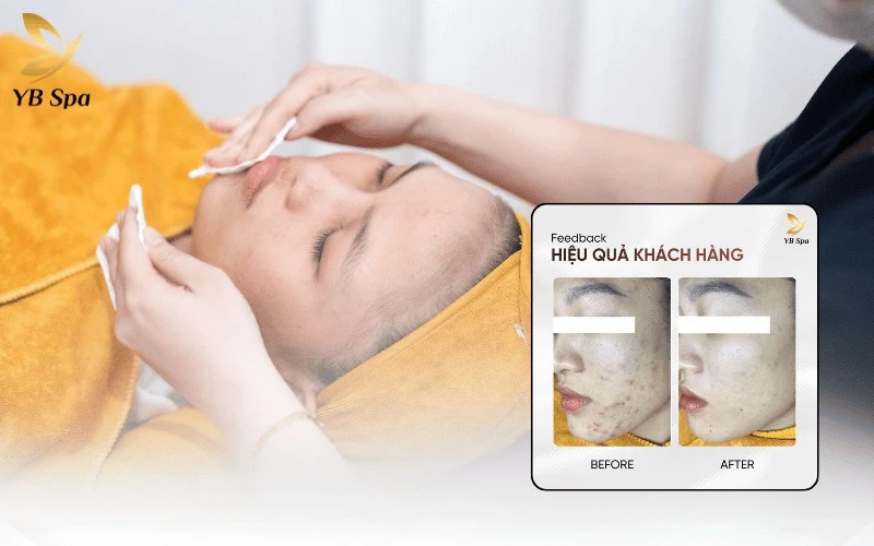 Xử lý triệt để các vấn đề về mụn và độc tố bằng quy trình chăm sóc da mặt chuyên sâu đạt chuẩn y khoa tại YB Spa