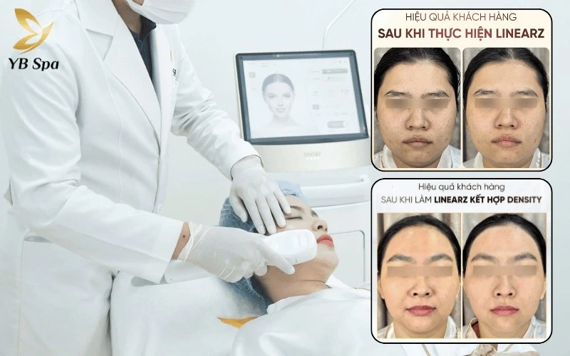Kết quả thực tế từ khách hàng là minh chứng thuyết phục nhất cho sức mạnh tái tạo Collagen và Elastin của công nghệ Density và Linear Z