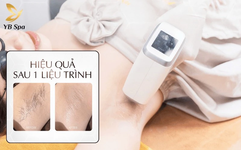 Triệt lông tận gốc không đau rát nhờ sự kết hợp giữa ánh sáng phổ rộng và công nghệ đầu kim cương lạnh -5°C hiện đại
