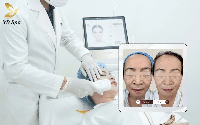 Nâng tầm nhan sắc với liệu trình nâng cơ không xâm lấn, mang lại hiệu quả định hình khuôn mặt và săn chắc da rõ rệt