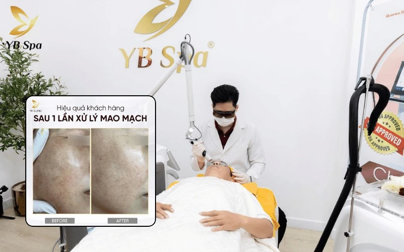 Laser Chrome tại YB Spa tác động chính xác vào các mạch máu siêu nhỏ, giúp điều trị giãn mao mạch hiệu quả mà không làm tổn thương vùng da xung quanh
