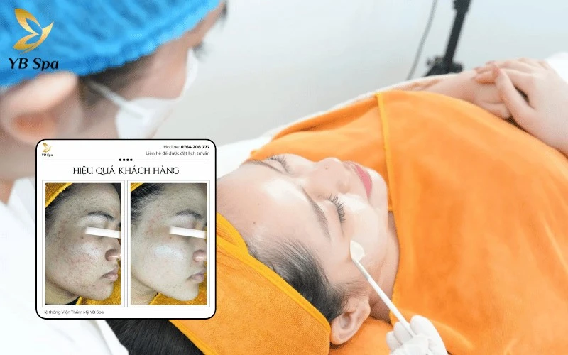 Top 10 Địa Chỉ Spa Quận 1 Uy Tín, Chất Lượng 2026 17 Xua tan nỗi lo về mụn với phác đồ khoa học giúp loại bỏ nhân mụn chuyên nghiệp và duy trì nền da khỏe mạnh, không tì vết