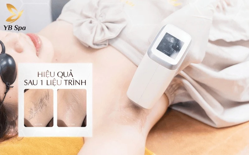 Trải nghiệm triệt lông mát lạnh âm 5 độ, êm ái, hạn chế tối đa bỏng rát cùng YB Spa