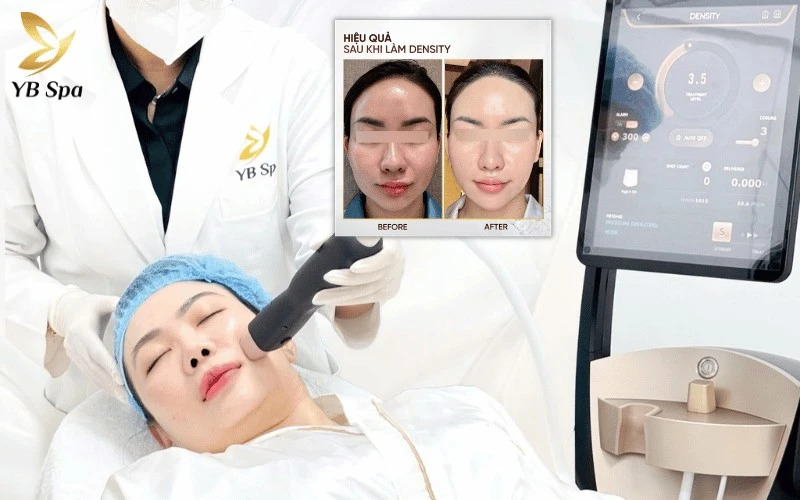Giải pháp nâng cơ Density là lựa chọn tối ưu để xóa mờ dấu hiệu lão hóa và phục hồi độ săn chắc cho làn da tại YB Spa