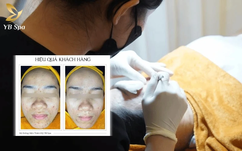 Phác đồ điều trị mụn chuẩn y khoa giúp lấy nhân mụn vô khuẩn và rút ngắn tối đa thời gian phục hồi vùng da viêm