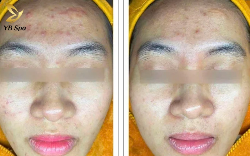 Top 5 Spa trị mụn Quận 2 an toàn, hiệu quả, chuyên sâu