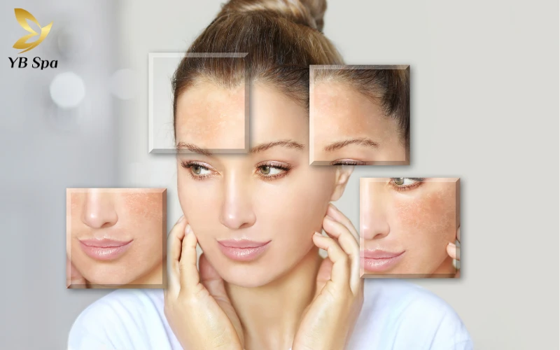 Top 5 Spa trị nám uy tín giúp làn da phục hồi rạng rỡ