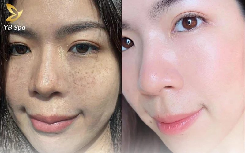 Kết quả thực tế từ khách hàng là thước đo chuẩn xác nhất, giúp bạn có cái nhìn khách quan về hiệu quả điều trị nám tại các spa uy tín.