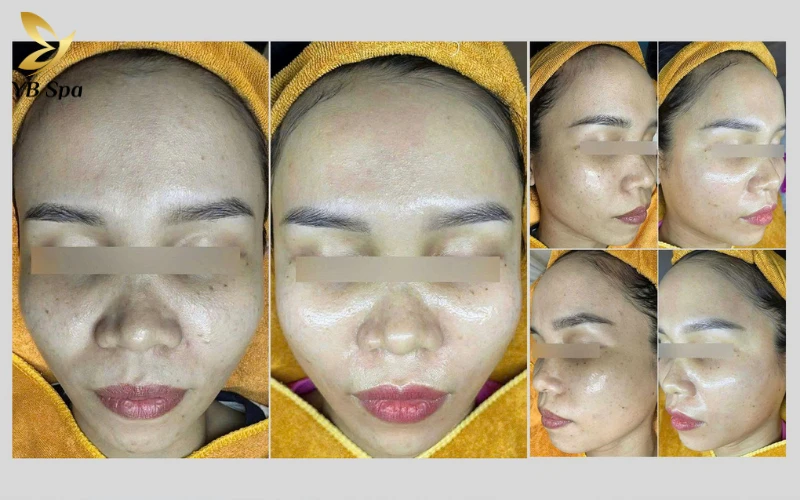 Sự thay đổi ngoạn mục: Hình ảnh thực tế trước và sau liệu trình cho thấy các mảng nám và đốm nâu đã mờ đi rõ rệt, trả lại làn da đều màu và rạng rỡ cho khách hàng.