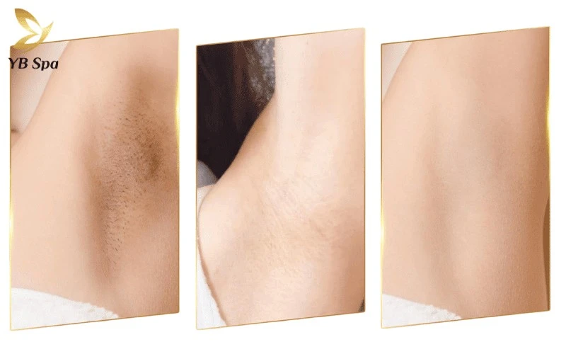 Top 6 Spa Trị Thâm Nách Hiệu Quả Tại Tphcm 11 Trải nghiệm trị thâm nhẹ nhàng, không gian vô khuẩn riêng tư và hiệu quả xóa mờ sần sùi nhanh chóng là những điểm cộng lớn của khách hàng YB Spa