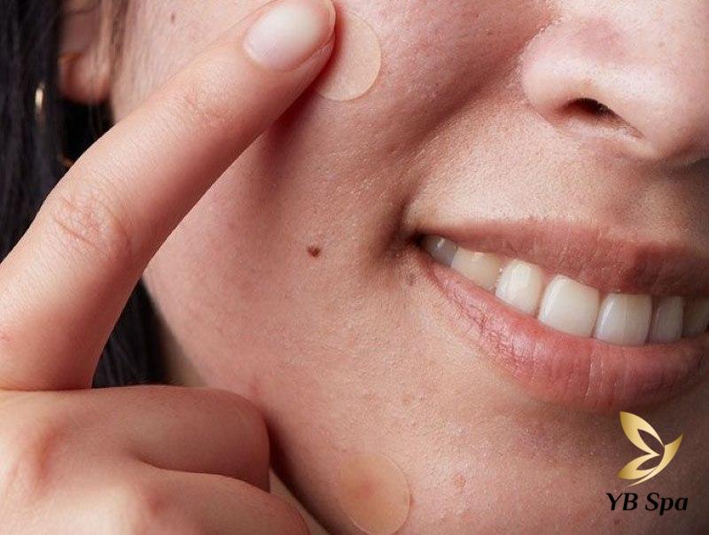 Tác hại của miếng dán mụn là gì? Cần lưu ý gì khi sử dụng? 19 Sử dụng miếng dán mụn