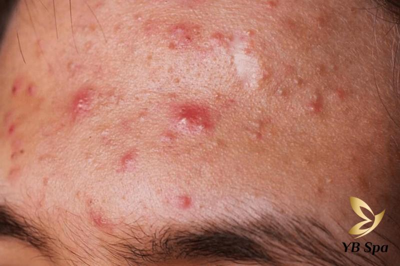 Tác hại của miếng dán mụn là gì? Cần lưu ý gì khi sử dụng? 20 Mụn viêm ở trên trán