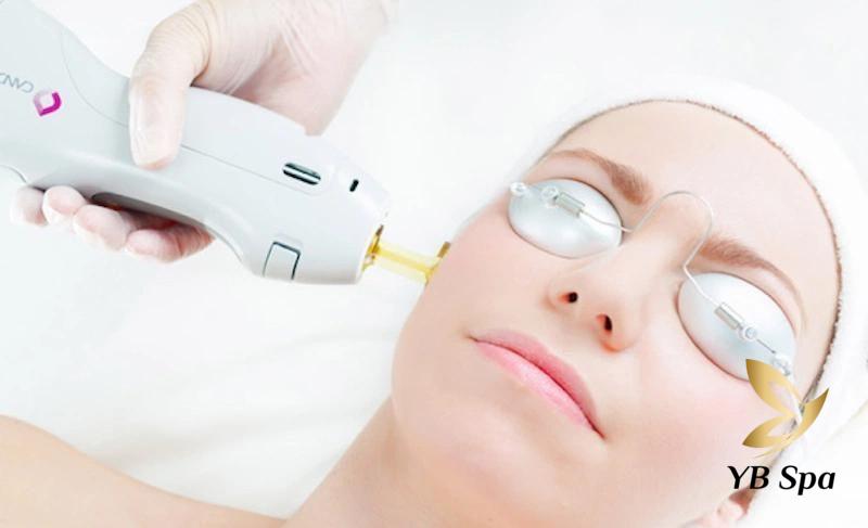 Tác hại của triệt lông mặt không đúng cách 18 Triệt lông mặt bằng ánh sáng IPL