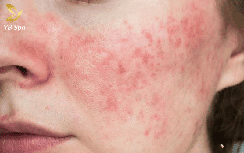 Bỏng nhiệt xảy ra khi năng lượng ánh sáng vượt quá ngưỡng chịu đựng, gây tổn thương trực tiếp lên lớp biểu bì mỏng manh