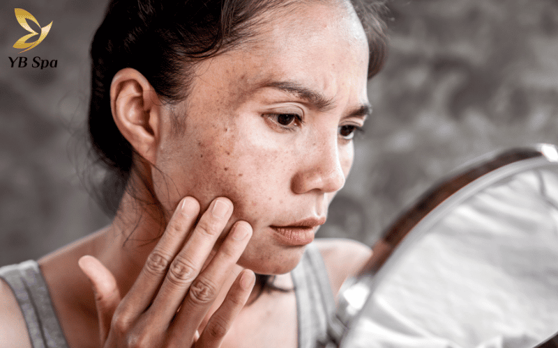 Triệt lông sai cách không chỉ dừng lại ở cảm giác nóng rát mà còn để lại những vết thâm sạm dai dẳng và cực kỳ khó điều trị