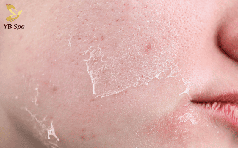 Tình trạng da luôn ửng hồng và châm chích là lời cảnh báo biểu bì đã trở nên quá mỏng và yếu ớt trước tác động môi trường