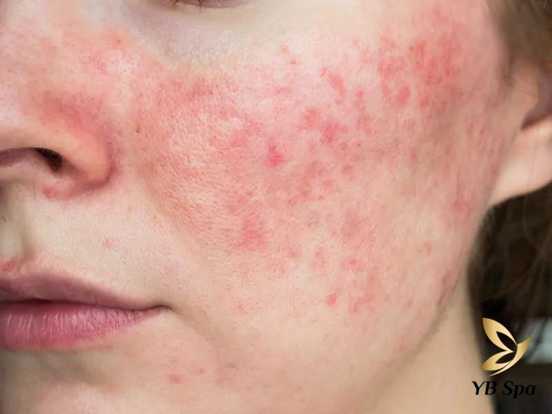 Tác hại của triệt lông mặt không đúng cách 17 Da bị kích ứng