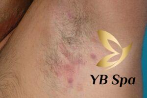 Viêm nang lông (Nguồn: Internet)