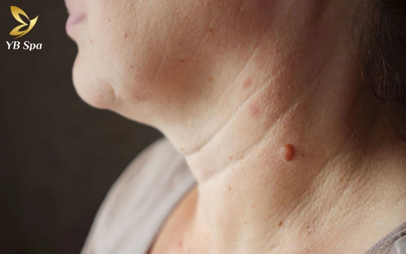 Tại sao bị nổi mụn thịt ở cổ? 19 Mụn Thịt Ở Cổ
