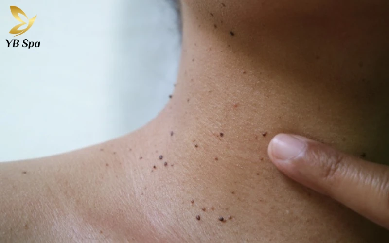 Tại sao bị nổi mụn thịt ở cổ? 20 Tại sao bị nổi mụn thịt ở cổ?