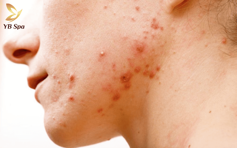 Cảnh giác với mụn mủ và sưng tấy sau triệt lông, vì đây là 'báo động đỏ' của tình trạng viêm nhiễm da nghiêm trọng