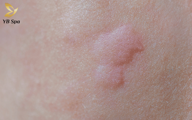 Phản ứng Histamine thực chất là cơ chế tự chữa lành thông minh của hệ miễn dịch khi làn da chịu tác động từ liệu trình triệt lông