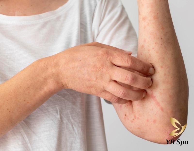 Tắm trắng có hại cho sức khỏe không? Những điều cần lưu ý 27 Da bị nổi mẩn đỏ kích ứng