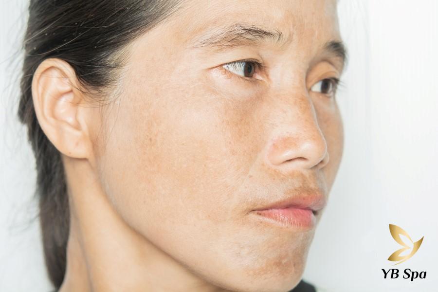 Bật mí 21 cách tắm trắng tại nhà bật tone nhanh cho chị em 24 Da mặt bị thâm sạm