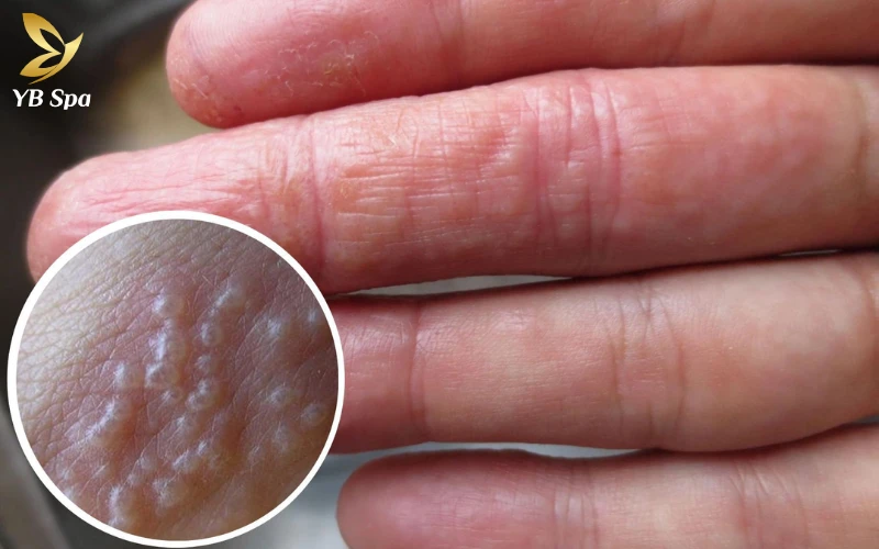 Tay bị nổi mụn nước ngứa phải làm sao