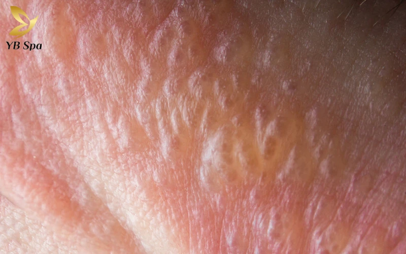 Tay bị nổi mụn nước ngứa là gì?