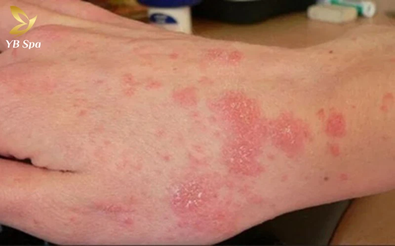 Chàm da (eczema), đặc biệt là chàm tổ đỉa
