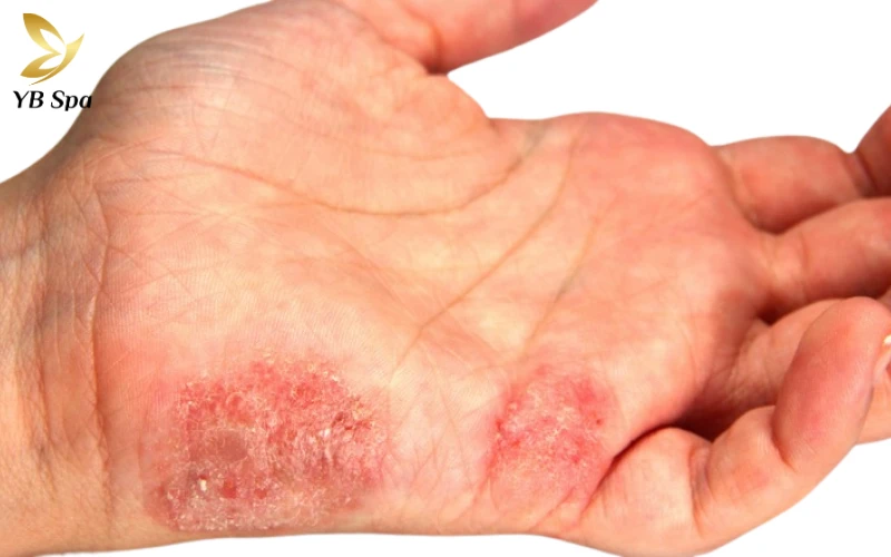 Nhiễm nấm da tay