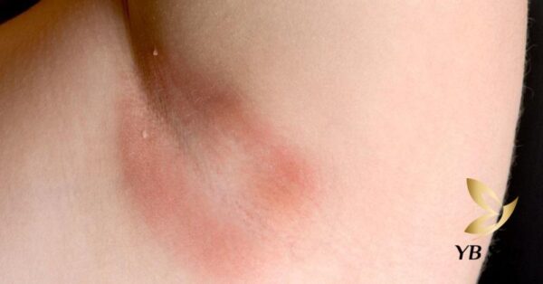 Tẩy lông nách bị rát phải làm sao