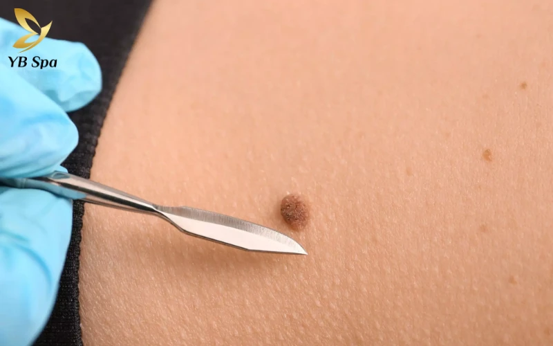 Tẩy nốt ruồi bị sẹo lõm phải làm sao? Nguyên nhân và cách xử lý hiệu quả 25 Phương pháp phẫu thuật cắt bỏ (Tiểu phẫu)