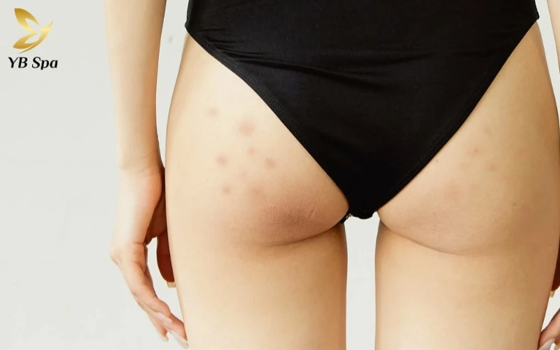 Lộ trình điều trị thâm mông theo 4 cấp độ từ nhẹ đến chuyên sâu 10 Khám phá bí quyết trị thâm mông tận gốc dựa trên cơ chế khoa học để bạn tự tin diện mọi trang phục