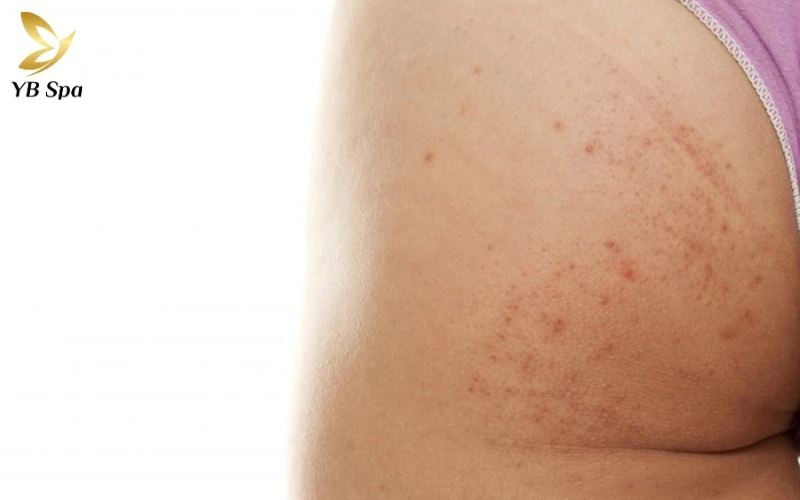 Lộ trình điều trị thâm mông theo 4 cấp độ từ nhẹ đến chuyên sâu 11 Thâm sau viêm (PIH) ở mông thường rất "lỳ lợm" do sắc tố nằm sâu, đòi hỏi quy trình xử lý chuyên sâu và kiên trì