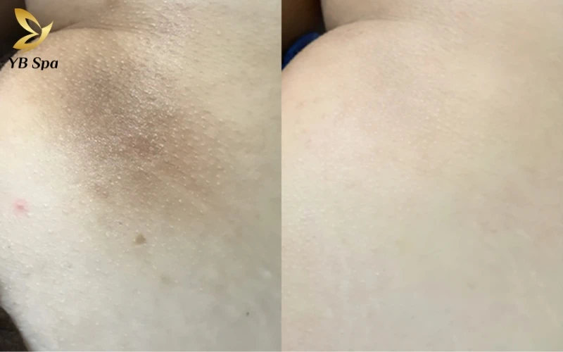 Lộ trình điều trị thâm mông theo 4 cấp độ từ nhẹ đến chuyên sâu 13 Ngồi nhiều và mặc đồ bó sát là nguyên nhân chính khiến da mông bị ma sát, dẫn đến hiện tượng sừng hóa gây thâm sạm