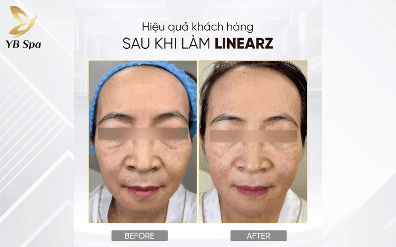 Top 8 Thẩm Mỹ Viện Quận 1 Uy Tín, Chất Lượng 2026 13 Khách hàng tận hưởng liệu trình nâng cơ LinearZ trong không gian sang trọng và cảm nhận kết quả thon gọn mặt rõ rệt chỉ sau 60 phút