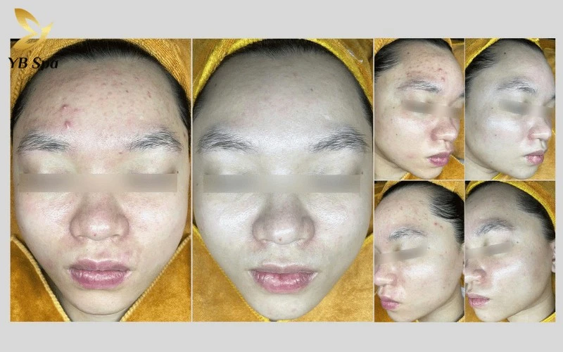 Top 6 Thẩm Mỹ Viện Quận 12 Uy Tín, Chất Lượng 2026 12 YB Spa mang đến phác đồ phục hồi chuyên sâu giúp hồi sinh hàng rào bảo vệ cho những làn da bị tổn thương nặng do Corticoid