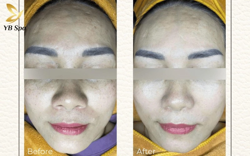 Sự thay đổi ấn tượng trên gương mặt chị Hoàng Lan với nền da mọng nước, đều màu nhờ công nghệ Meso hiện đại