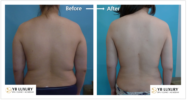 Giảm mỡ thân trên CẤP TỐC thon gọn tay vai lưng HIỆU QUẢ 27 Than Tren 1