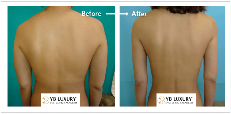 Giảm mỡ thân trên CẤP TỐC thon gọn tay vai lưng HIỆU QUẢ 28 Than Tren 3