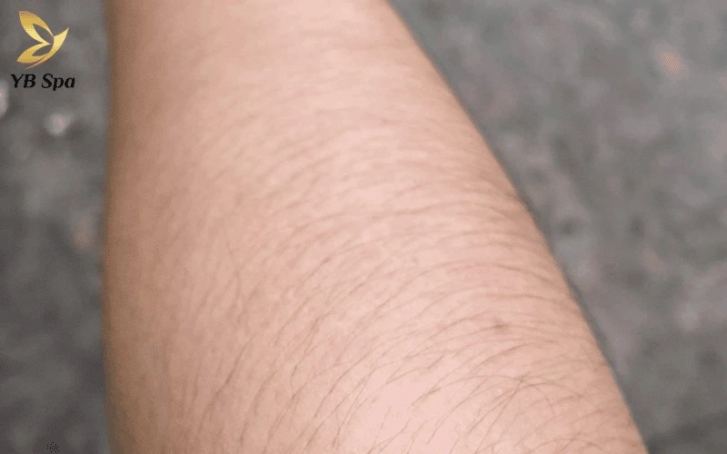 Việc "an toàn quá mức" khi dùng thông số yếu vô tình khiến khách hàng mất thêm nhiều thời gian và chi phí cho một liệu trình kéo dài