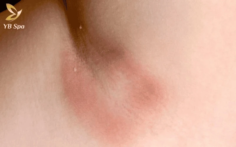 Bỏng da là hệ quả của việc melanin ở lớp biểu bì hấp thụ nhiệt quá mức thay vì tập trung năng lượng vào nang lông