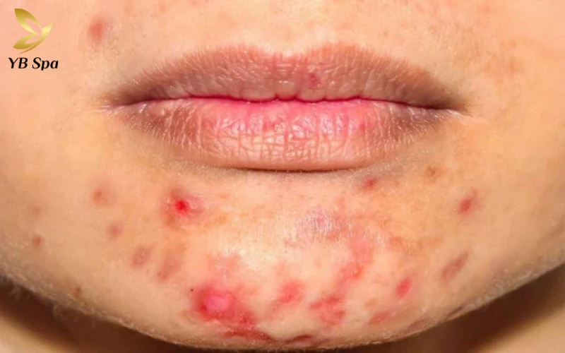 Chế độ ăn ảnh hưởng thế nào đến mụn nội tiết?