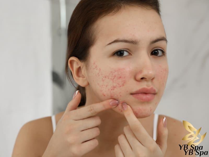 Thức khuya có nổi mụn không? Ảnh hưởng đến da như thế nào? 22 Việc thức khuya thường xuyên không những ảnh hưởng đến sức khỏe mà còn gây hại cho làn da, dẫn đến tình trạng da bị nổi mụn.