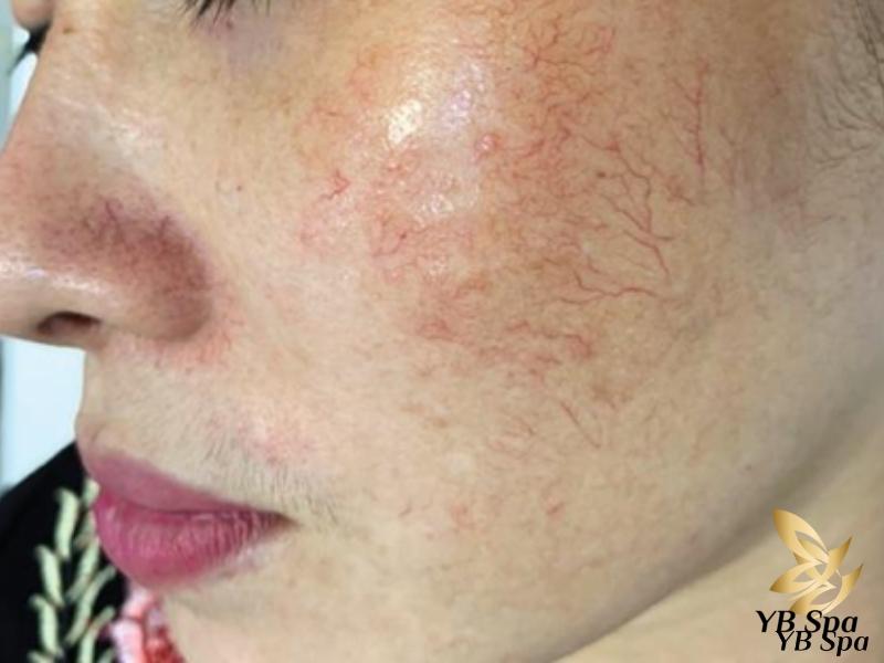 Thuốc rượu trị mụn là gì? Có nên dùng thuốc rượu trị mụn? 24 đây là những giai đoạn mà làn da có thể trải qua nếu sử dụng thuốc rượu không đúng cách
