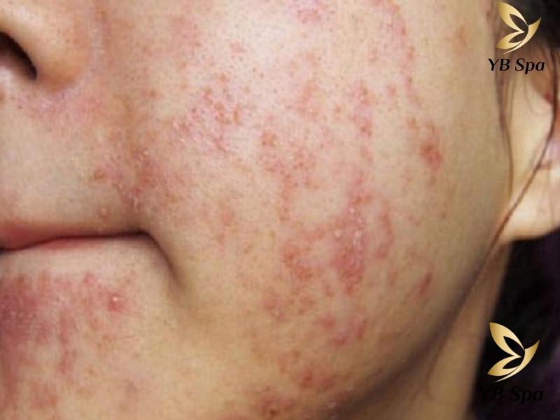 Thuốc rượu trị mụn là gì? Có nên dùng thuốc rượu trị mụn? 25 Nếu bạn nhận thấy da mình bị tổn thương sau khi sử dụng thuốc rượu trị mụn, việc quan trọng